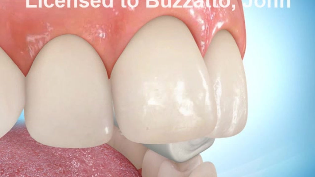 Direct Bonding (Self-Etching Primer)